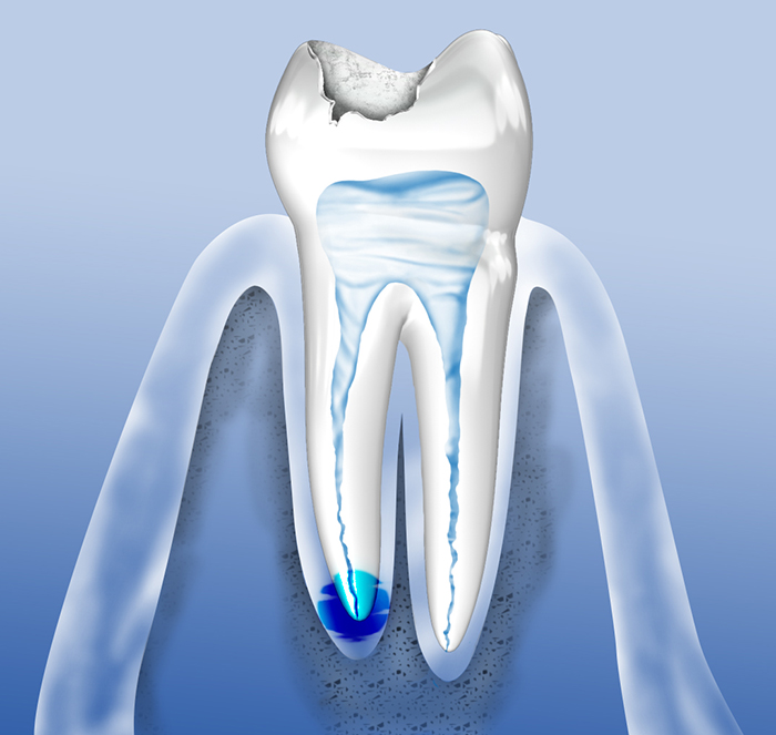 Wann Ist Eine Wurzelbehandlung Erforderlich