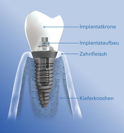 Implantat inklusive Zahnkrone
